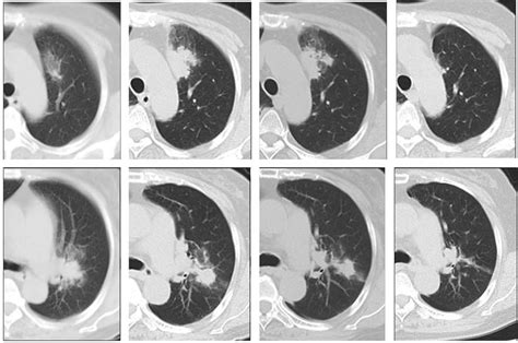 Chest Computed Tomography Ct Imaging During The Clinical Course At