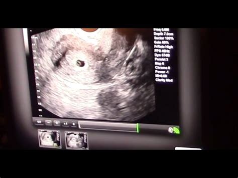We did not find results for: Our 5 week ultrasound! (10.5.2015 - Day 302) - YouTube