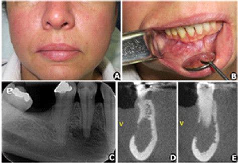 A Extraoral Examination Showing Lack Of Facial Swelling B Intraoral