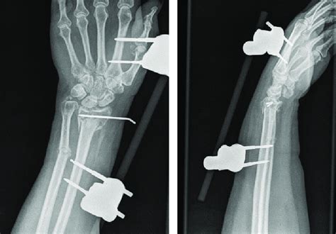 A Comminuted Displaced And Intra Articular Fracture Of The Distal