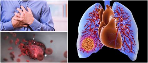 Embolia Pulmonar Definici N Causas S Ntomas Diagn Stico Tratamiento Y Prevenci N Arriba Salud