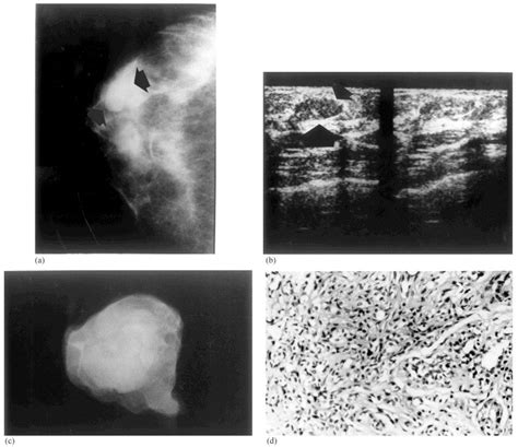 Sclerosing Adenosis Mammographic And Ultrasonographic Findings With