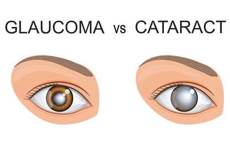 Glaucoma Vs Cataracts Understanding The Difference