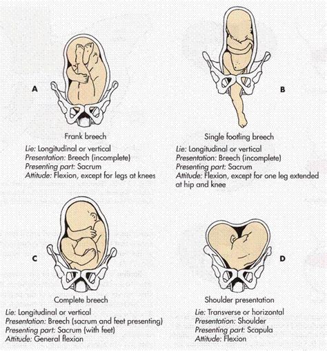Fetal Presentations A C Breech Sacral Presentation D Shoulder