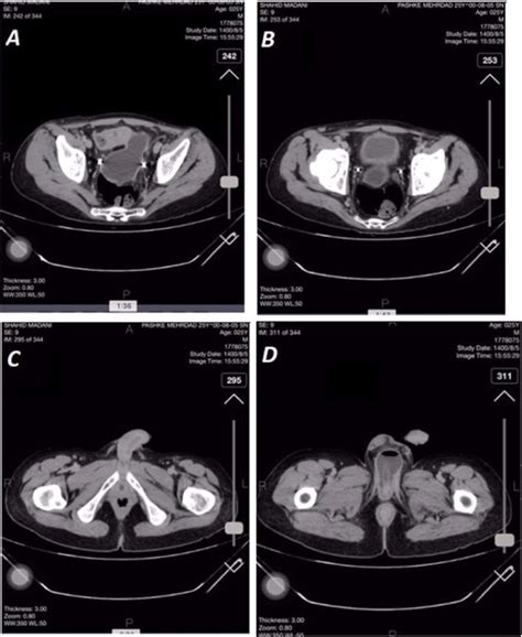 The Abdominopelvic Ct Scan Before Removing The Foreign Object
