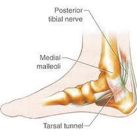 How A Damaged Nerve In The Foot Causes Back Pains Youtube