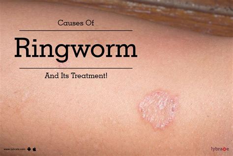 Causes Of Ringworm And Its Treatment By Dr Shivashankar B