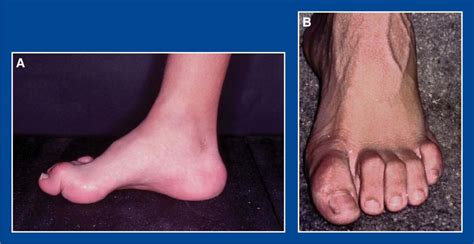 Foot And Ankle Deformities Musculoskeletal Key