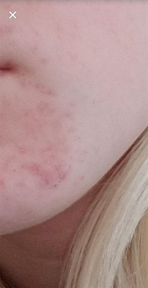 Acne affects teenagers and also grownups. How to get rid of the redness Acne : SkincareAddiction
