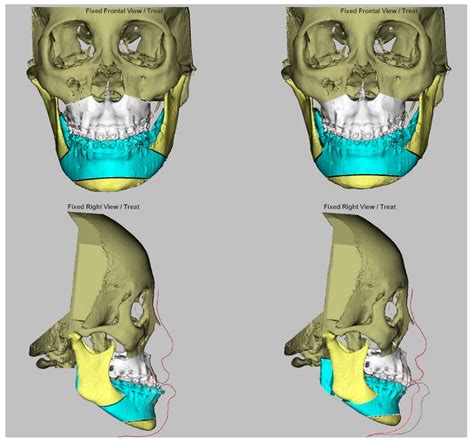 Jcm Free Full Text Effect Of Le Fort I Maxillary Advancement And