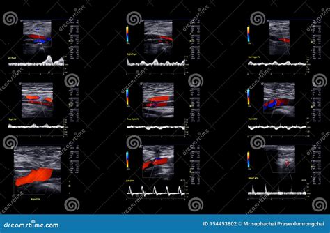 Ultrasound Doppler For Finding Deep Vein Thrombosis Stock Photo Image