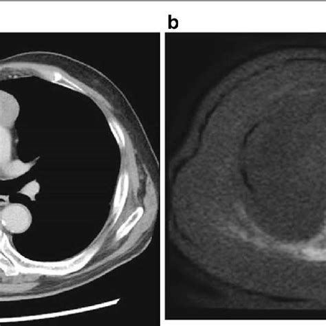 Tumor Appearance On Diagnostic Imaging A Computed Tomography Showing A