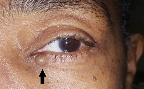 Benign Eyelid Growths Chalazionstyes Cassandra B