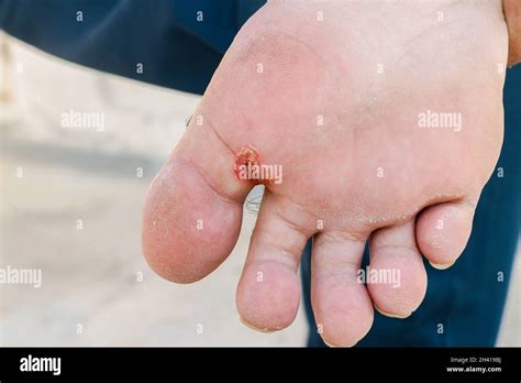 Athletes Foot Tinea Pedis Fungal Infection Or Sole Of The Feet With