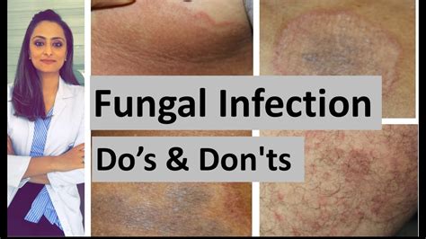 Fungal Infection Of Skin Dos And Donts Dermatologist Dr