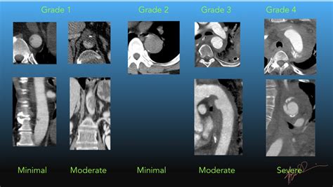 Classification Of Blunt Traumatic Aortic Injury Uw Emergency Radiology