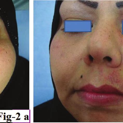 Distribution Of Vascular Lesions In The Face Download Table