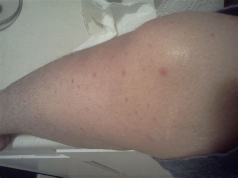 Itchy Feel Swollen Feet Red Dots All Over Legs