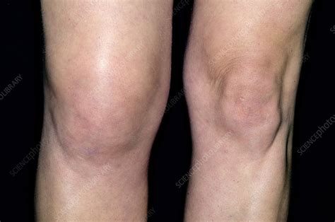 Knee Swelling Stock Image C0213400 Science Photo Library