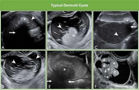 Ultrassonografia Em Ginecologia Dr Glaucius Nascimento