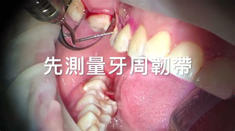 顯微牙周病治療，牙齦下牙結石刮除治療牙齦流血gum Treatment Youtube