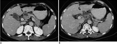 Images Show Gallbladder Tuberculosis In 58 Year Old Woman A