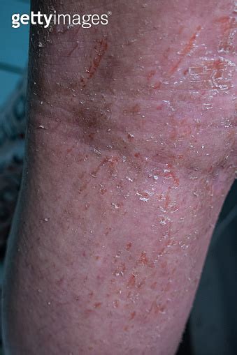 Back Of The Knee And Leg Of A Young Woman Who Has Atopic Dermatitis 이미지