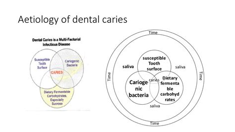 Dental Caries Its Etiology