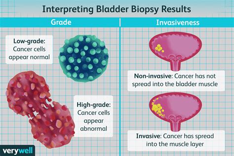 Understanding Your Bladder Biopsy