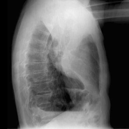 Lateral Chest X Ray Labeled