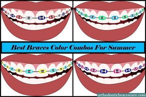 31 Unique Braces Colors And Combinations For Summer Orthodontic Braces Care