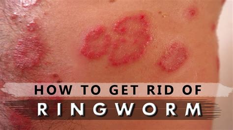 Ringworm Treatment Home Remedies How To Get Rid Of Ri