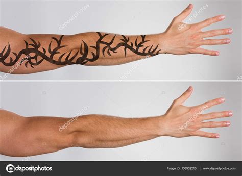 Laser Tattoo Removal — Stock Photo © Andreypopov 138902210