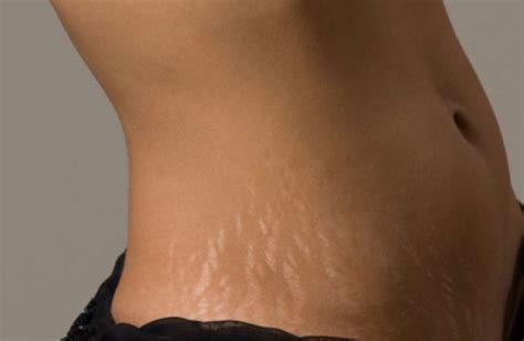 Get Rid Of Stretch Marks Using Home Remedies Stephanie Daily