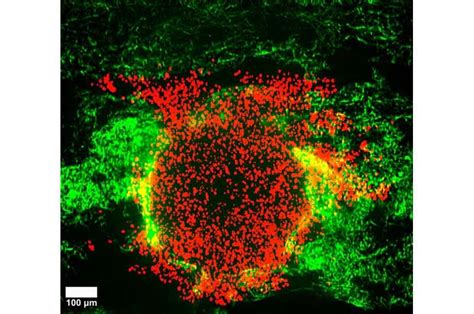 Burst Of Rapid Cell Motion In 3d Tumor Model Could Explain Cancer