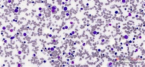 Mds With Excess Blasts Learnhaem Haematology Made Simple