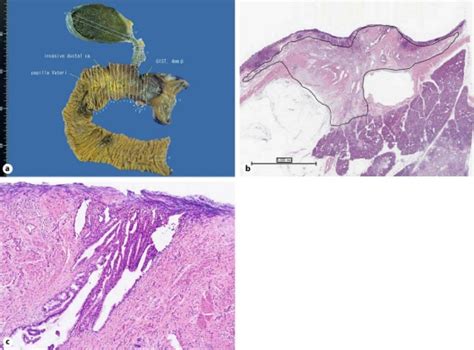 A A Resected Specimen Of The Duodenum Showed An Irregularly Elevated