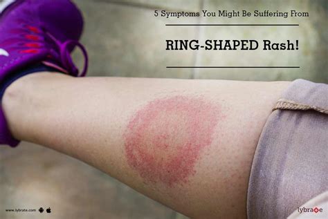 5 Symptoms You Might Be Suffering From Ring Shaped Rash By Dr H R