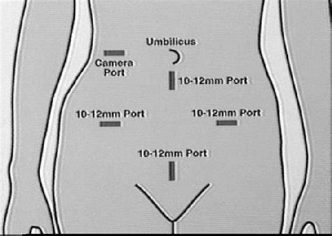Diagram Of Placement Of Five Ports For Sigmoid Colectomy Download