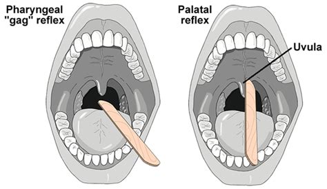 cranial nerves ix and cn x testing procedures palatal reflex and gag reflex