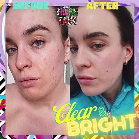 💘🌟clear Complexion🌟💘 This Isnt Just About Sorting The Breakout How