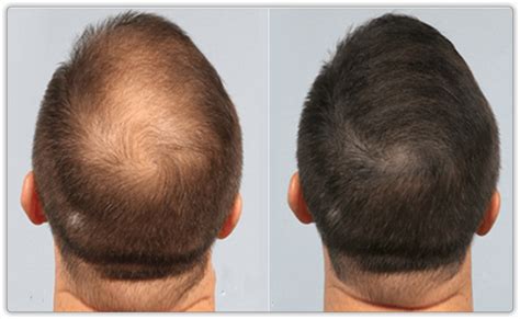 Hair Restoration Treatments In Toronto And Mississauga Lip Doctor