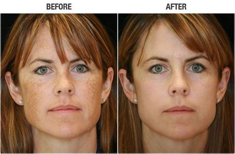 Ipl Photofacial Before And After 1 Treatment Charisse Mezquita