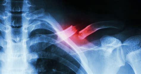 Fractures Of The Shoulder New Iberia La Orthopedic Surgery Wm