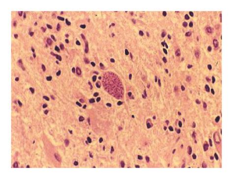 A Toxoplasma Cyst Demonstrated On H And E Stain ×40 B Toxoplasma