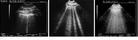 Figure 2 From A Lines And B Lines Lung Ultrasound As A Bedside Tool