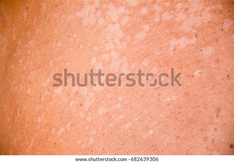 Tinea Versicolorpityriasis Versicolor On Skin Stock Photo Edit Now