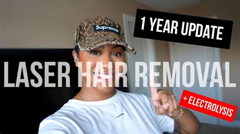 Laser Hair Removal 1 Year Update Electrolysis Zoerudd Youtube