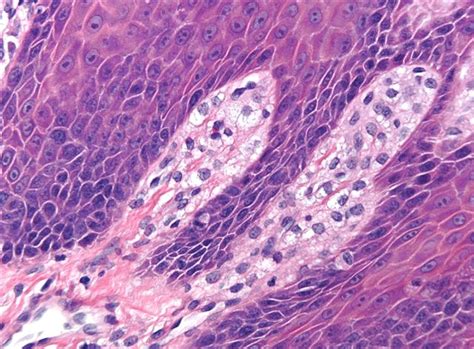 Pathology Outlines Verruciform Xanthoma