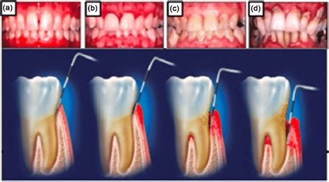Anatomical Illustration Of The Evolution Of Periodontal Diseases From A